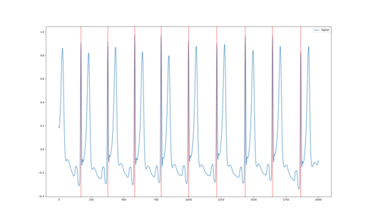 ECG visualisation