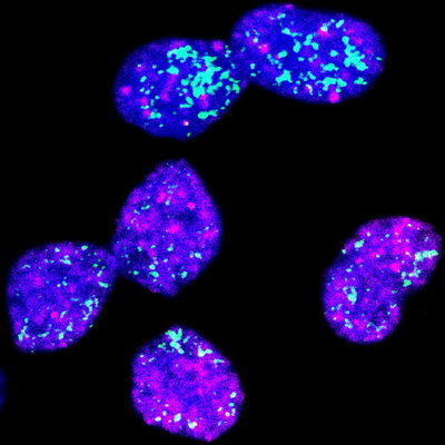 Das Foto zeigt das Neuroblastom-Zellen, in denen das Onkogen MYCN türkis angefärbt ist. Pink ist eine Veränderung im Chromatin, die für schlafende Zellen charakteristisch ist. Die Zellkerne sind blau markiert. Gut zu sehen ist, dass sich Zellen mit wenigen Kopien des MYCN-Gens vermehrt im Ruhezustand befinden. © Charité | Giulia Montuori (mit freundlicher Unterstützung der Technologieplattform „Advanced Light Microscopy“ des Max Delbrück Center)