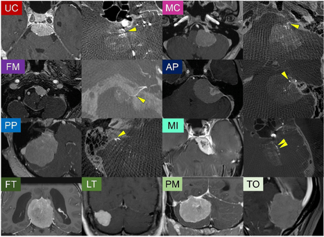 Integrated molecular and detailed anatomical profiling identifies a prognostically adverse subtype of posterior fossa meningiomas: high-risk copy number alterations are associated with midline predilection and predict poor prognosis | Acta Neuropathologica Communications