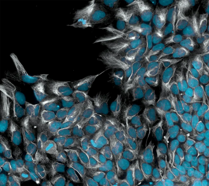 Induced pluripotent stem cells undergoing directed differentiation into early ectoderm. The blue nuclei signify the presence of the Pax6 gene, while the intricate white filaments outline Nestin.